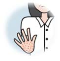 掌蹠膿疱症のイメージ画像